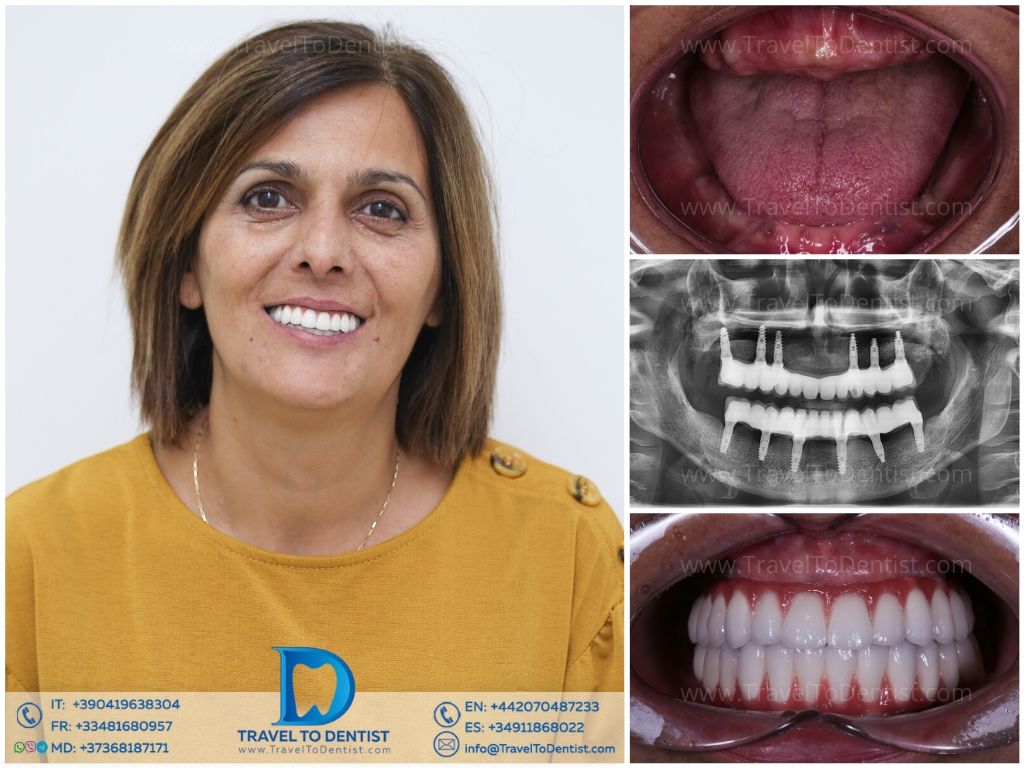 Caso 5 — Resultado dental