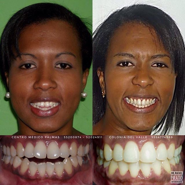 Caso 4 — Resultado dental